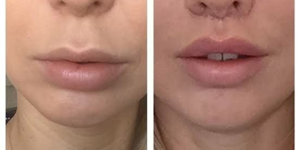 Bullhorn Lip Lift in Dubai: Expert Tips for Best Results