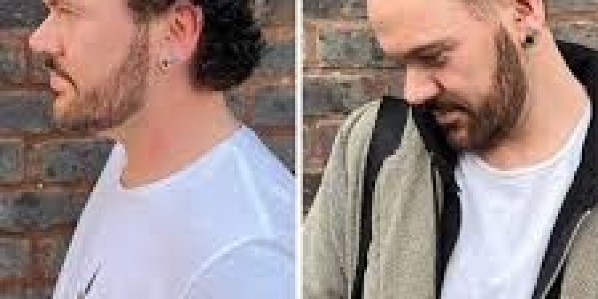 Why Modern Hair Systems Are Transforming Confidence for Men