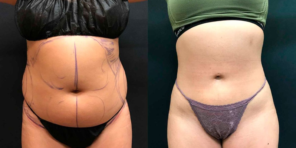 The Future of Liposuction in islamabad in an Appearance-Focused Era