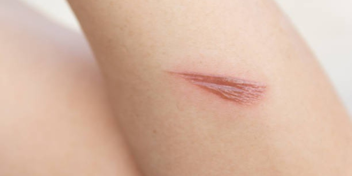 Why Some People Are More Prone to Keloids