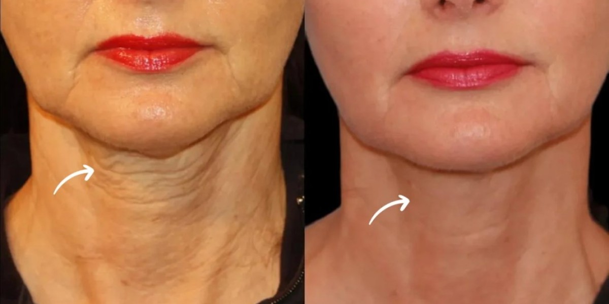 Best Aesthetic Clinic in Dubai for Sculptra Fillers Muscle Contouring