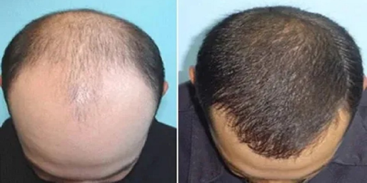 Hair Transplant in Dubai: Why It Is the Top Choice