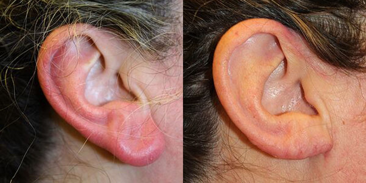 Earlobe Correction for Repairing Large Holes