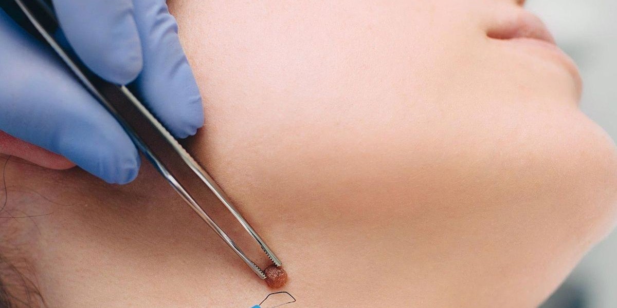 Modern Techniques for Mole Removal in Dubai