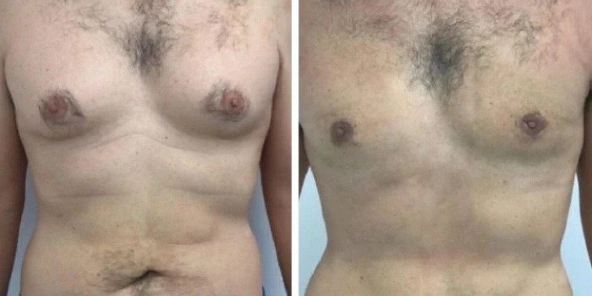 Teenage Concerns and Gynecomastia in Dubai Treatment Options