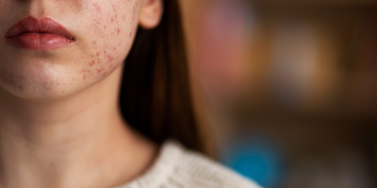 Types of Acne Scars and Their Treatment Options in Jayanagar