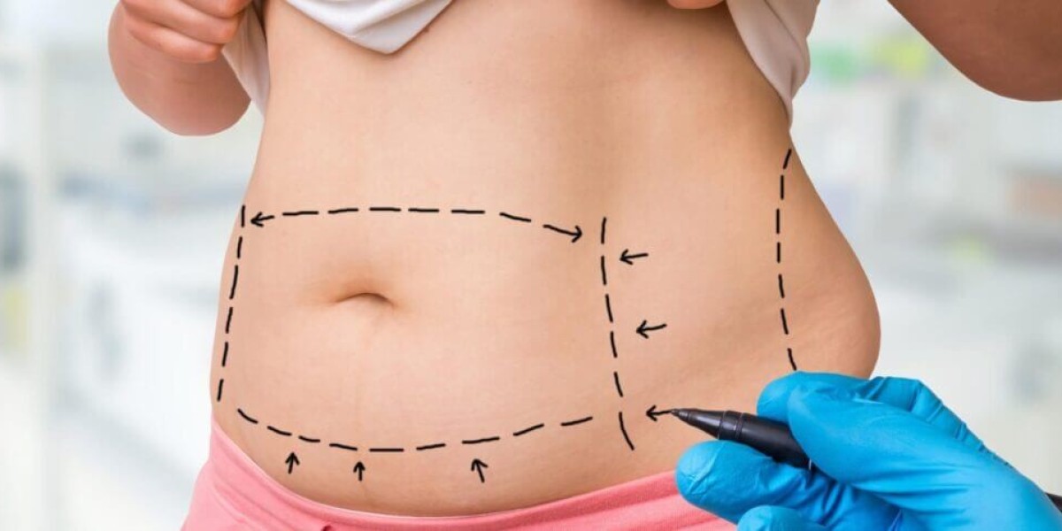 360 Liposuction Dubai: A Complete Guide to Full-Body Contouring