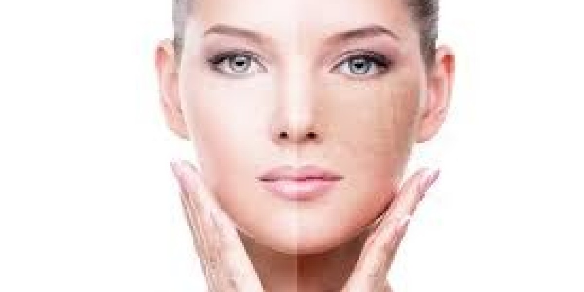 Laser Treatment For Stretch Marks and Stretch Mark Removal Treatment: A Complete Guide to Effective Skin Rejuvenation