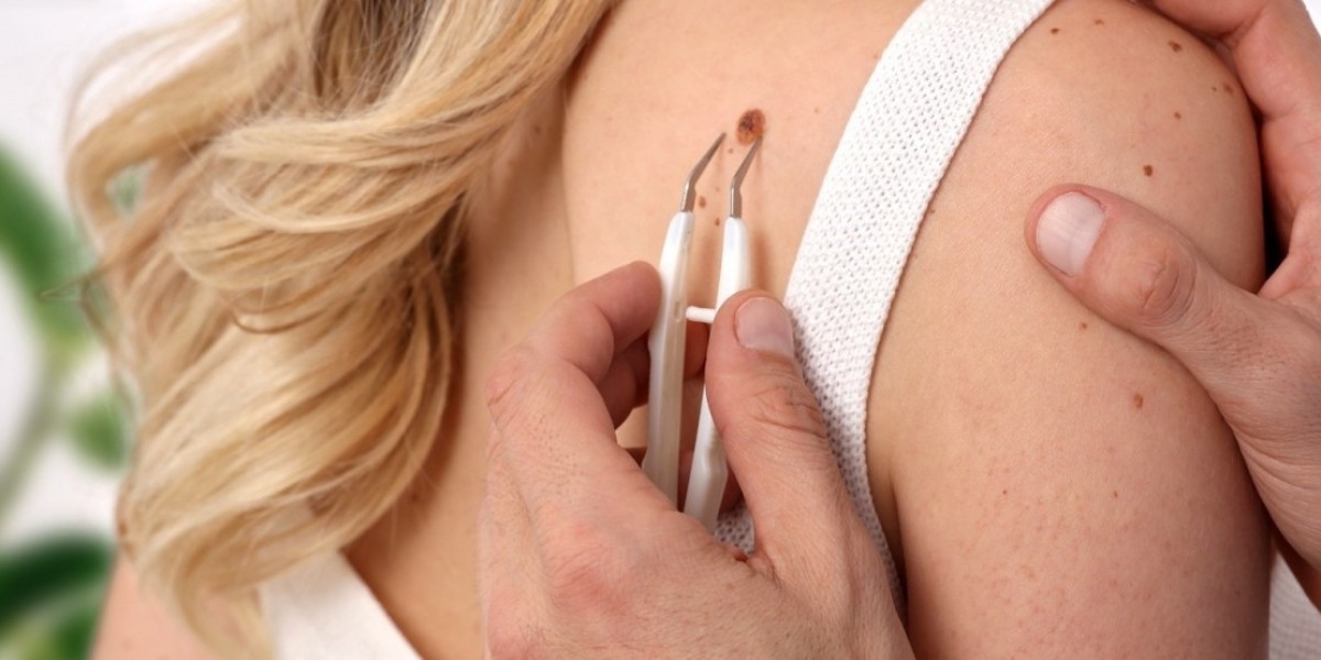 The Increasing Popularity of Laser-Based Mole Removal in Islamabad