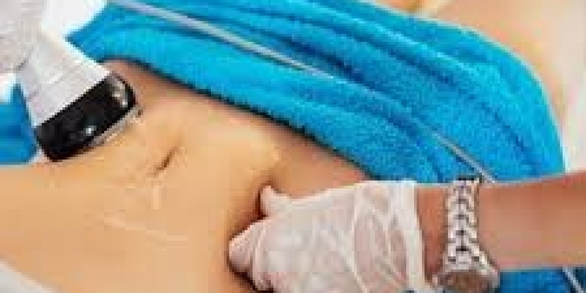 How does liposuction improve body proportions after fat reduction?