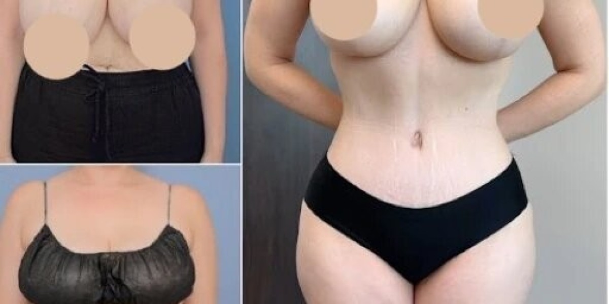 Best Tummy Tuck Surgeons in Dubai for Perfect Results