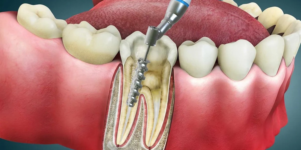 Keep Your Smile Fresh with Regular Root Canal Treatments