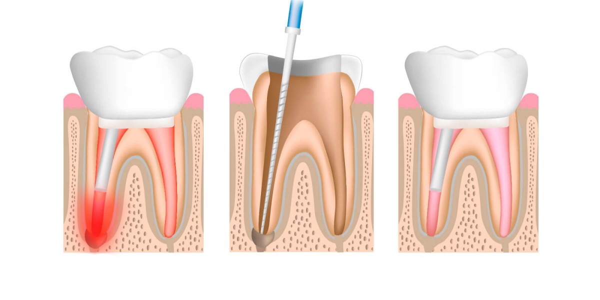 Root Canal Cost in Dubai for Severe Tooth Decay
