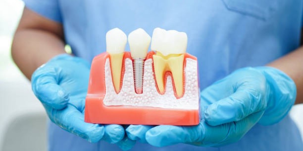 How Bone Grafts Support Successful Dental Implant Treatment