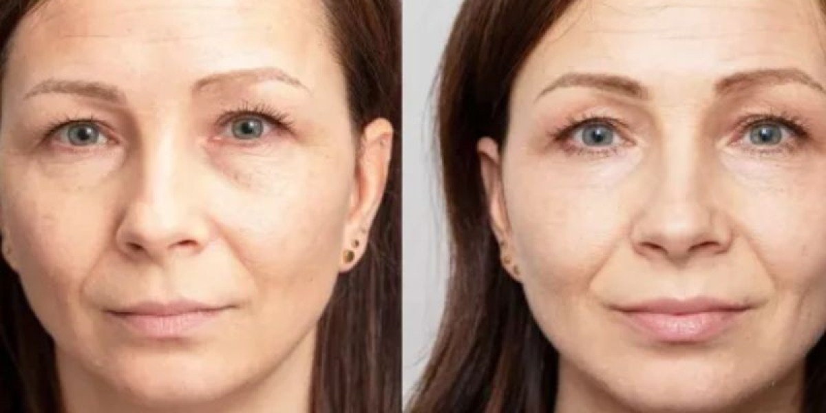 Collagen Stimulation Treatment for Youthful, Firm Skin | Your Skin Expert
