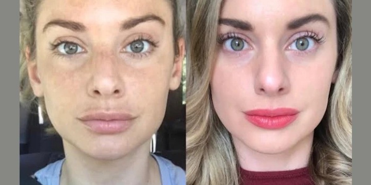  Best Plastic Surgeon in Dubai for: Microneedling Treatments