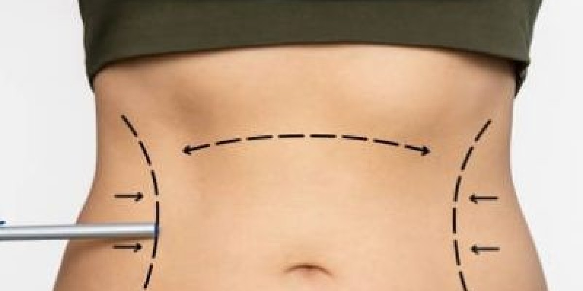 Everything You Need to Know About Liposuction Surgery in Dubai