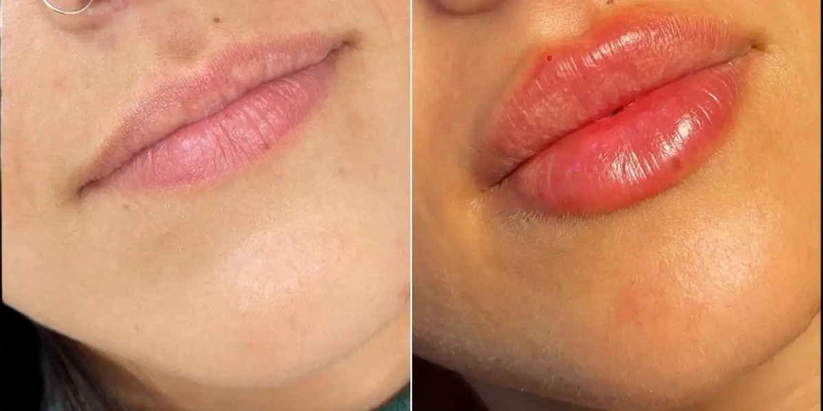Glow Enhancement with Fillers Best Plastic Surgeon in Dubai Experts
