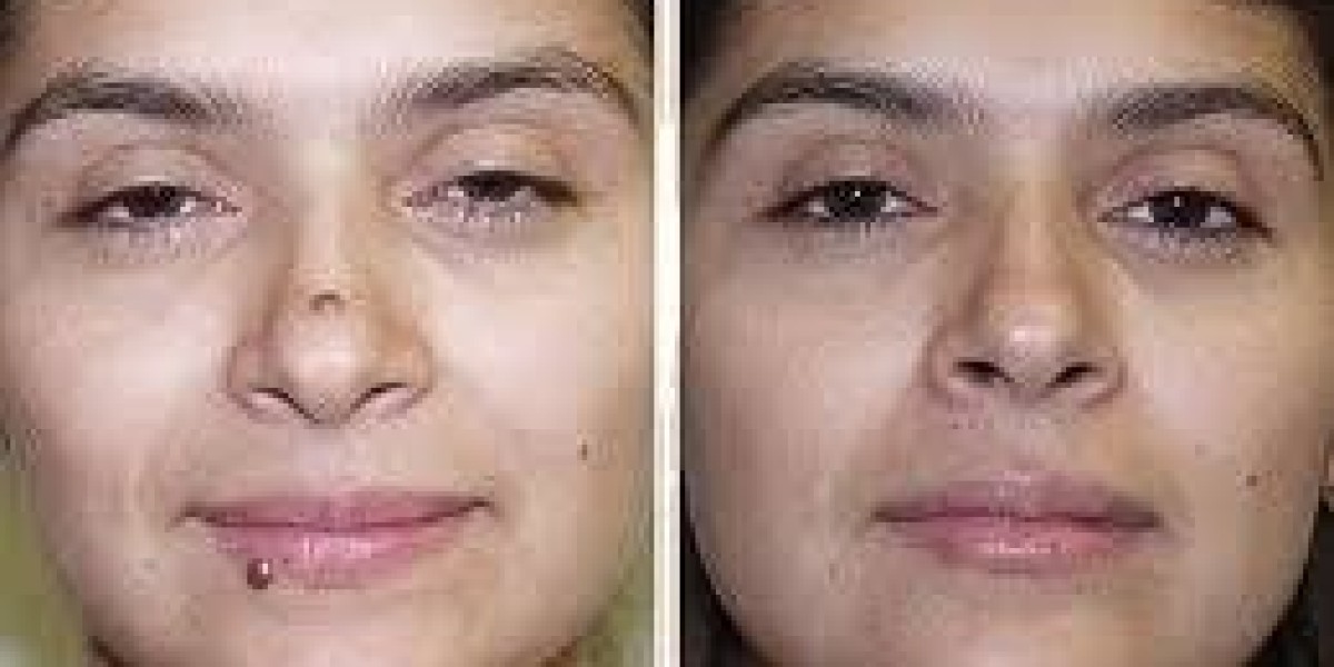 Mole Removal in Dubai – Everything You Need to Know for Clearer Skin