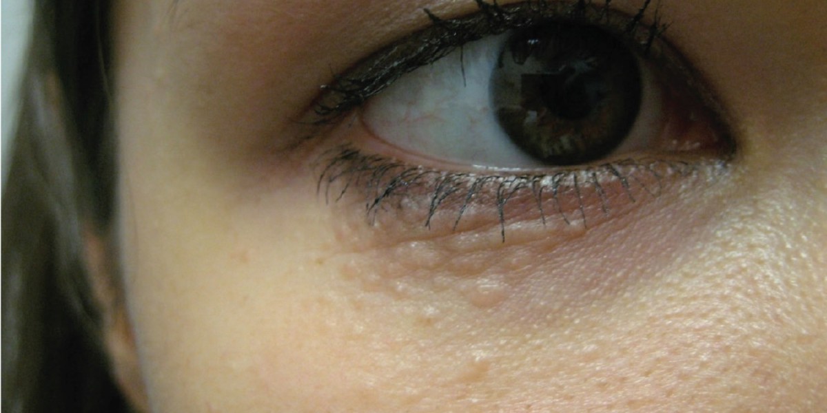 7 Reasons to Choose Enfield Royal Clinic for Syringoma Removal