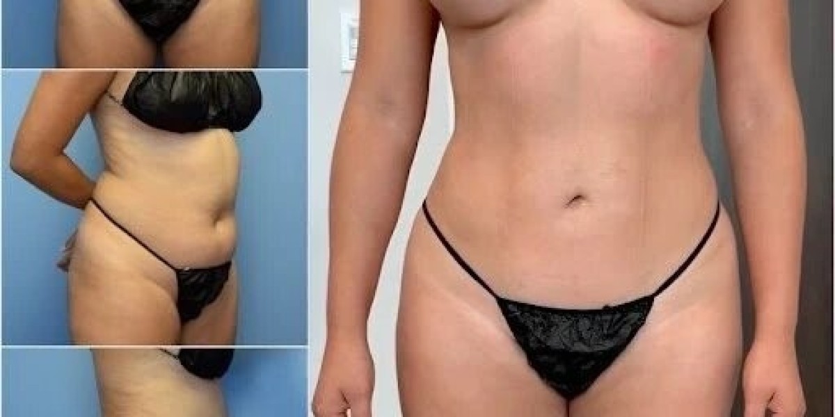 Achieve Your Dream Body with Best Body Contouring Surgeons in dubai