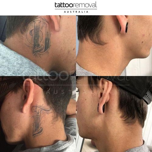 Where to Get Your Tattoo Removed in Gold Coast | Full Guide