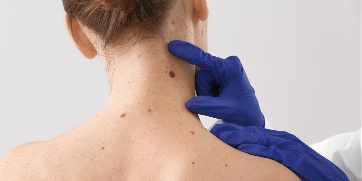 Can Mole Removal Be Done Comfortably?