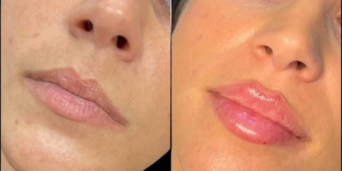 Safety Measures for Dermal Fillers by Leading Best Doctors in Dubai