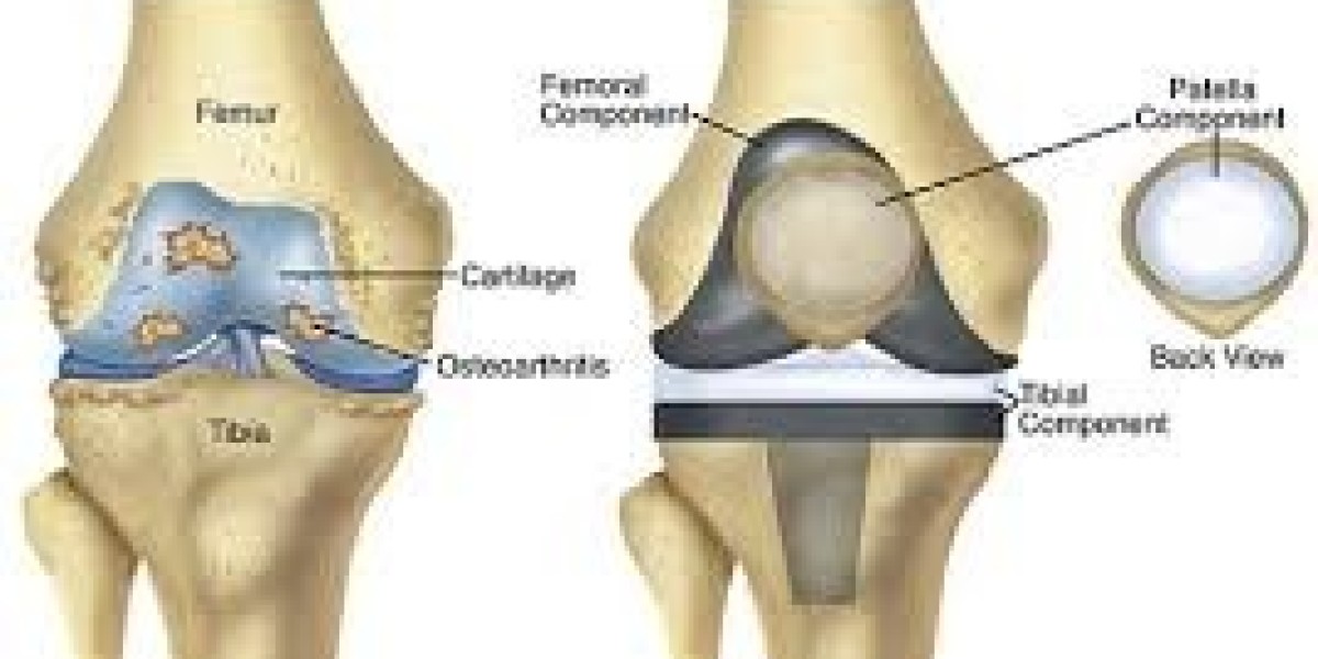 Understanding the Cost of Knee Replacement Privately What You Need to Know
