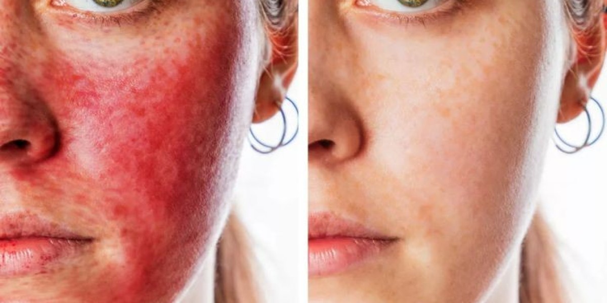 Vampire Facelift in Dubai: Restoring Facial Vitality