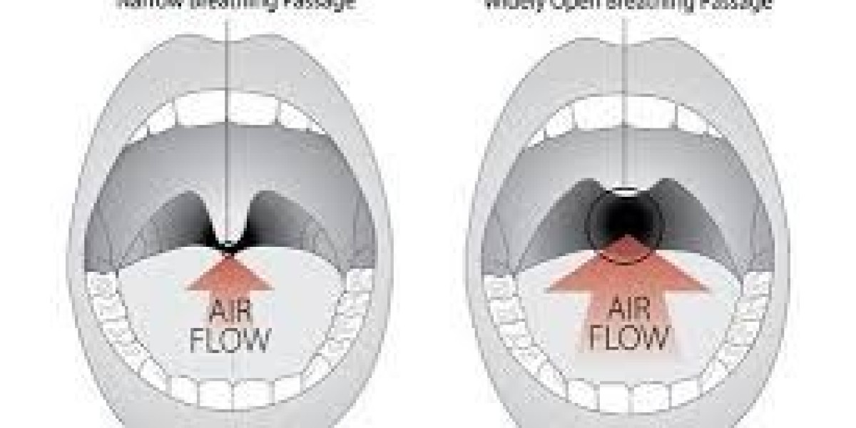 How Lifestyle Changes Complement Snoring Treatment in Dubai for Better Sleep Quality