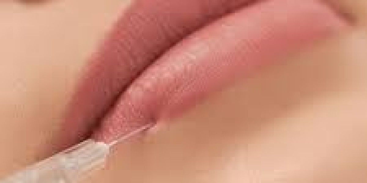 Best Volbella Fillers For Lip in Dubai for Subtle Lip Definition