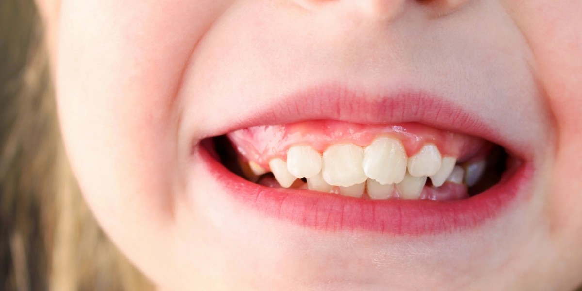 Expert Overlapping Teeth Treatment in Islamabad for a Straighter and Healthier Smile