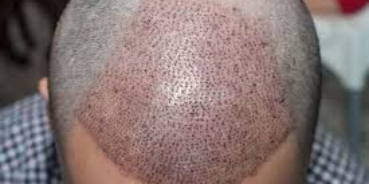 Hair Transplant in Dubai: Myths vs Facts You Should Know
