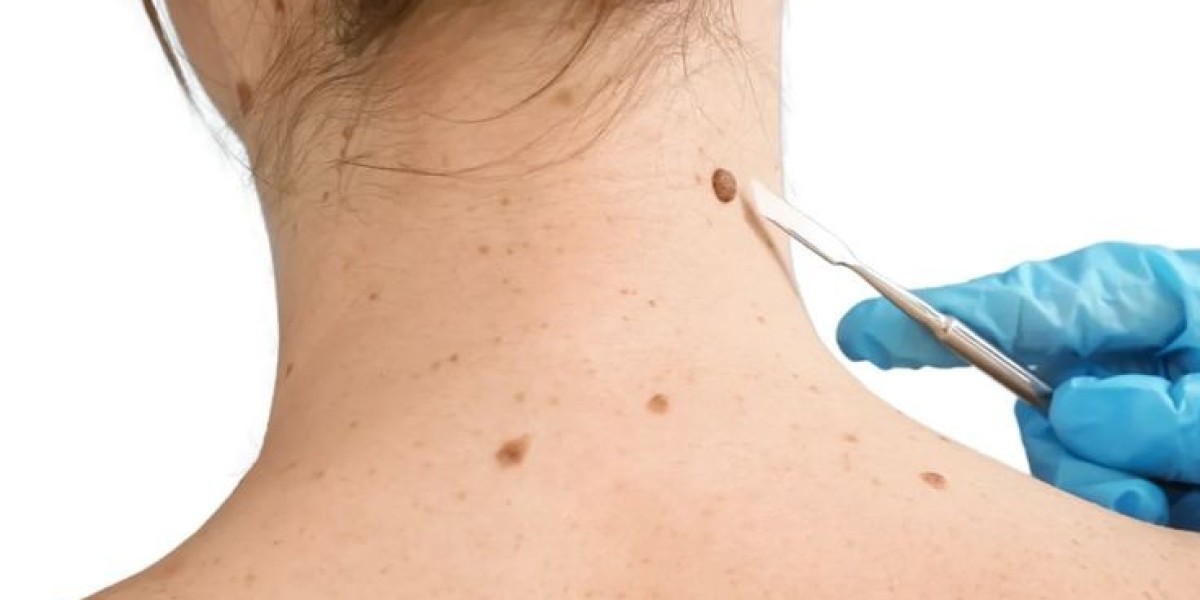 Mole removal in Dubai: Expert Surgical Precision