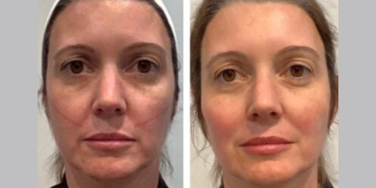 Best Plastic Surgeons in Dubai Supporting Professional Thread Lift