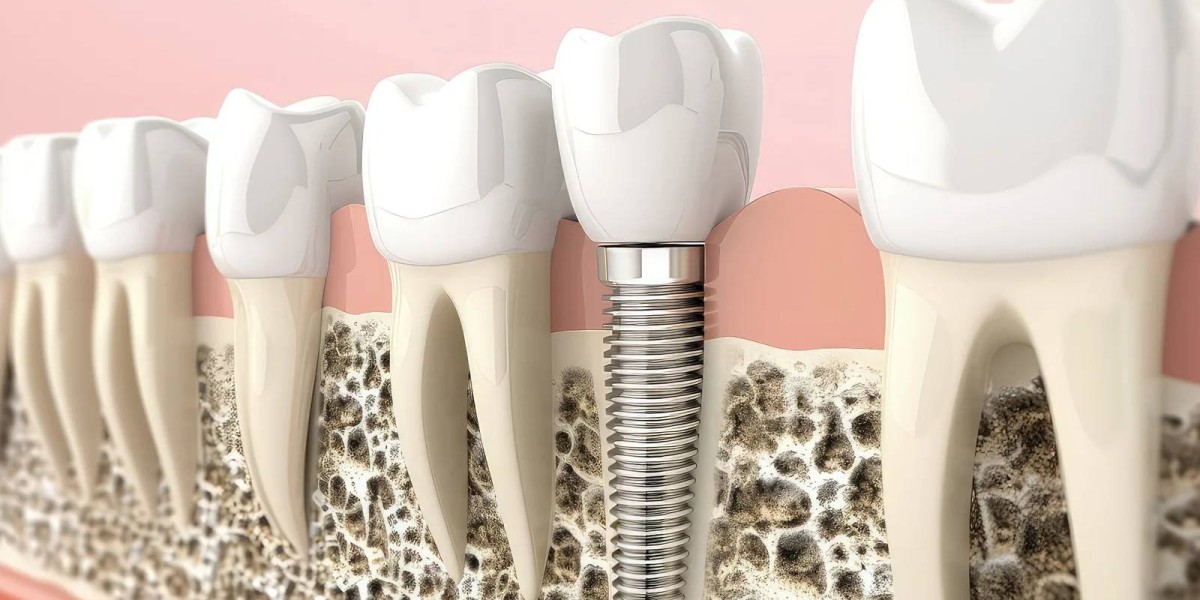 Success Rate of Dental Implants in Dubai