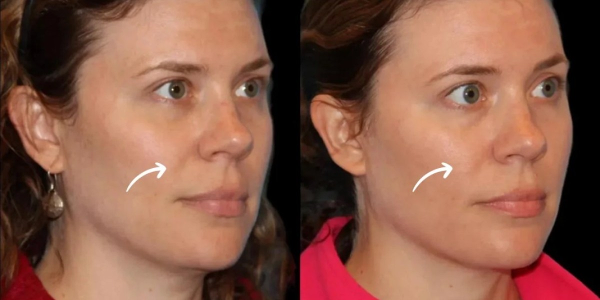 Best Plastic Surgeon in Dubai Explains Sculptra Fillers Progress