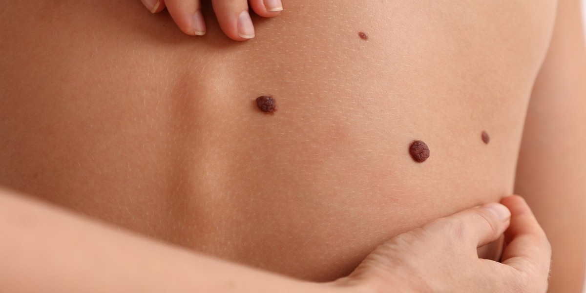 Why Skin Tag Removal Is Becoming Popular Among Men and Women in Islamabad