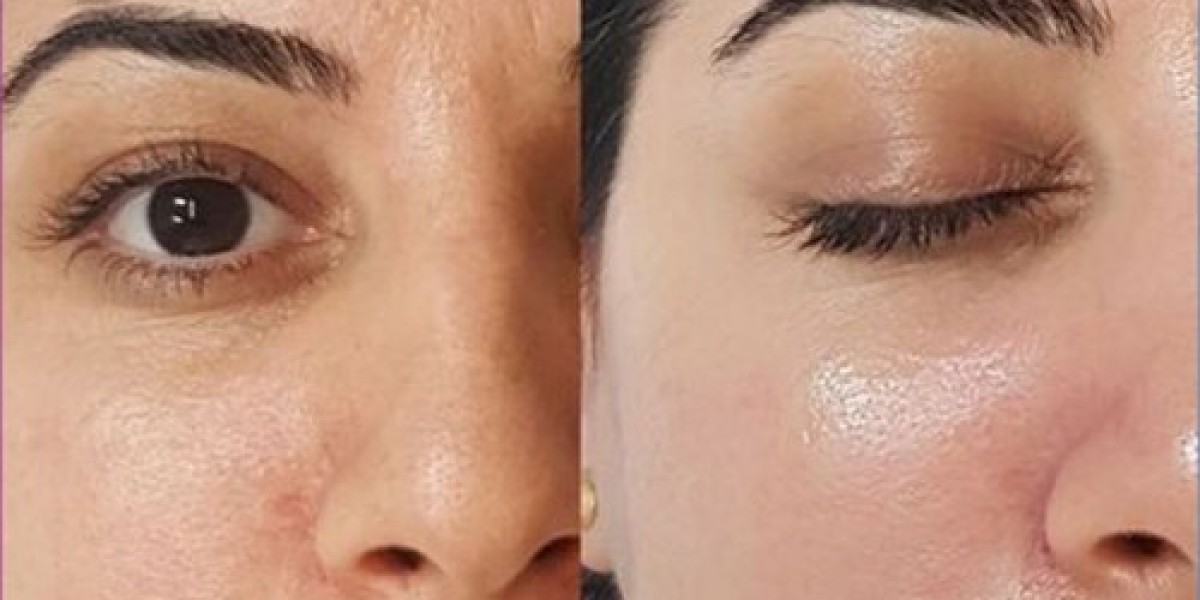 How to Choose an Authentic Whitening Injection in Pakistan: A Guide to Bio Rae and Other Premium Brands