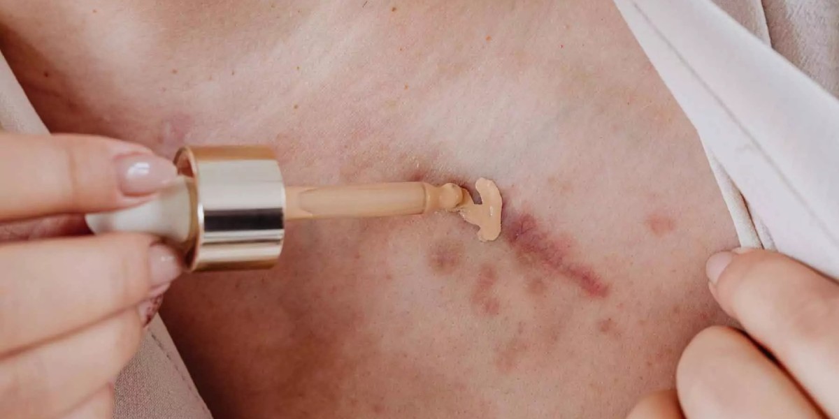 Top Professional Providers of Scar Camouflage in Dubai