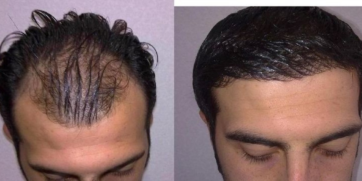 Hair Transplant in Dubai for Men with Hair Loss