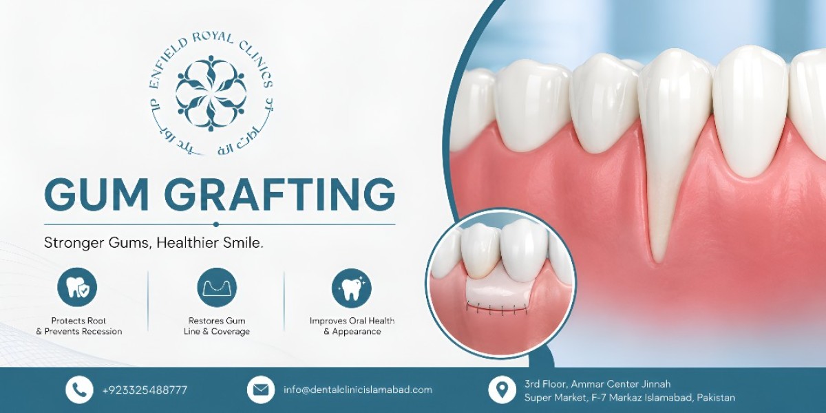 Gum Grafting in Islamabad with Advanced Dental Care