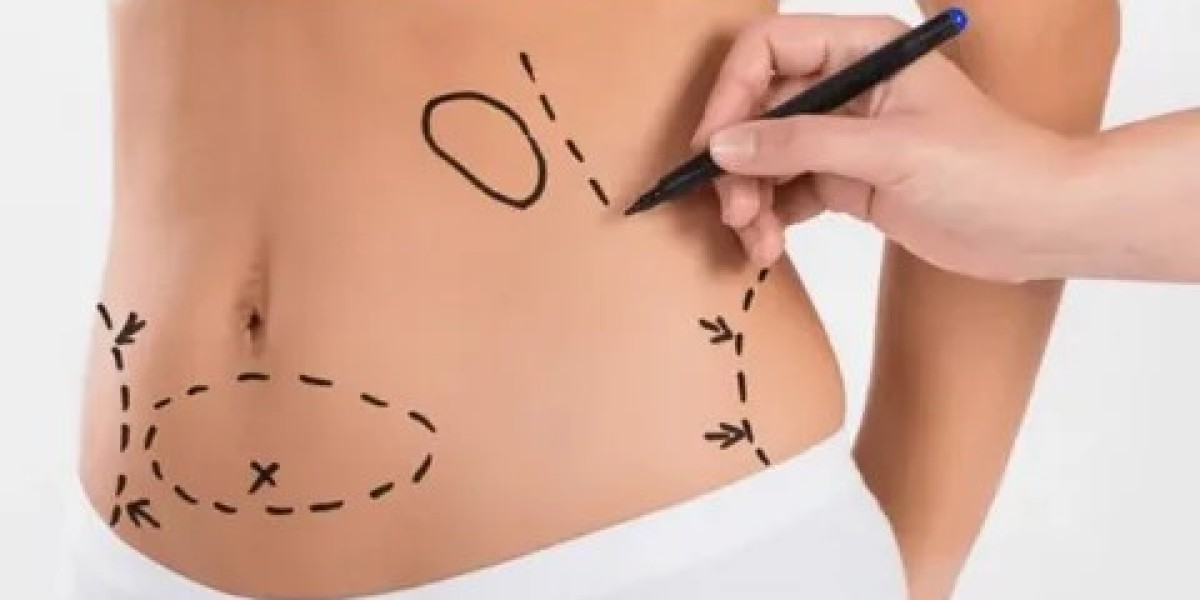 Tummy Tuck in Dubai: The Path to Abdominal Excellence