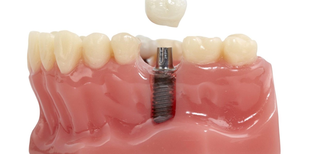 Root Canal Specialist Dubai for Emergency Care