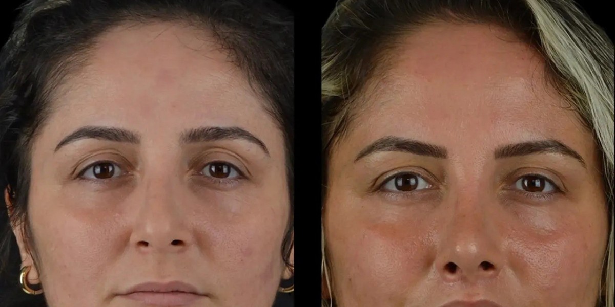 Cheek Fillers Procedure Explained by Best Doctors in Dubai