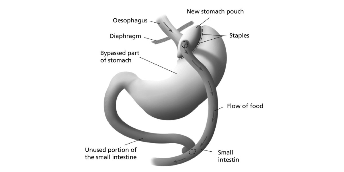 Gastric Bypass Surgery for Women Benefits and Considerations