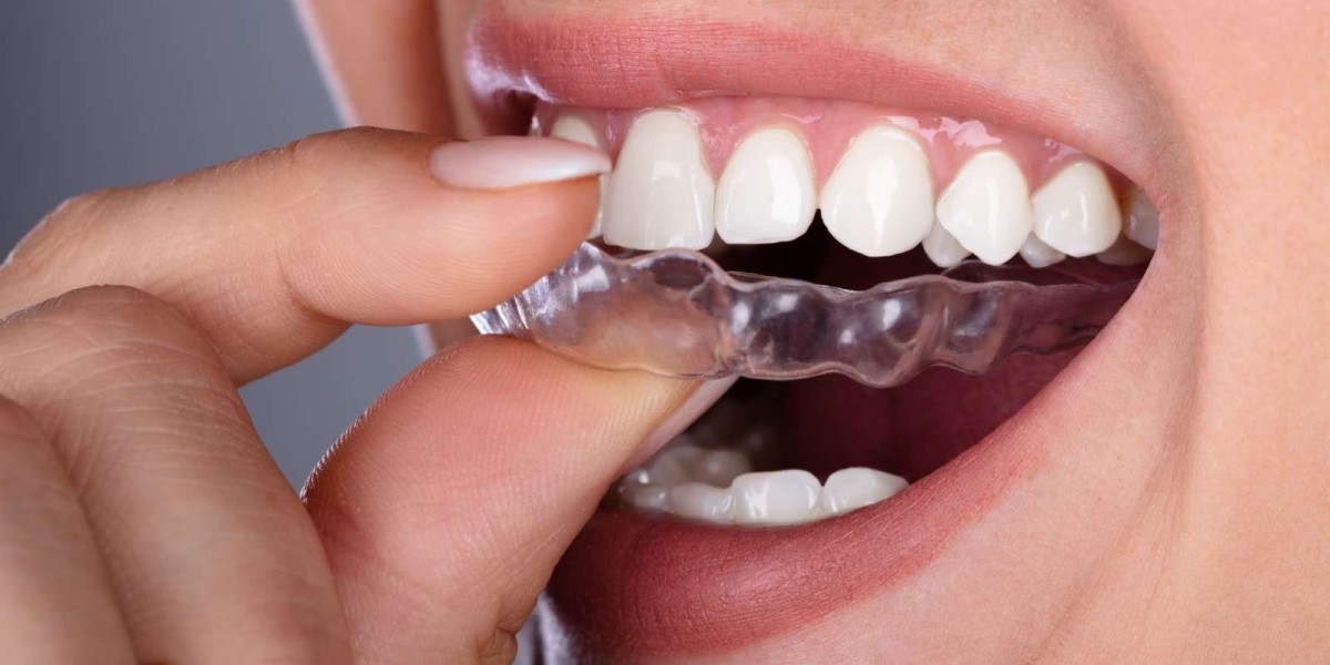 Dental Braces: How They Improve Teeth Alignment