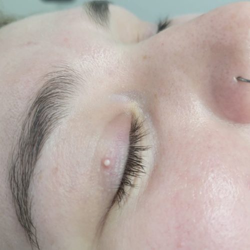 Milia Removal in Milton Keynes | Call at 770-383-0047