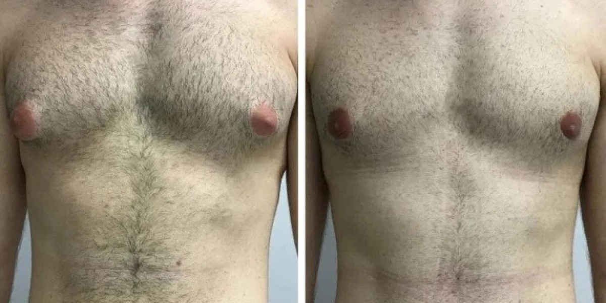 Best Gynecomastia Surgeon in dubai: Preparing for Surgery and Recovery